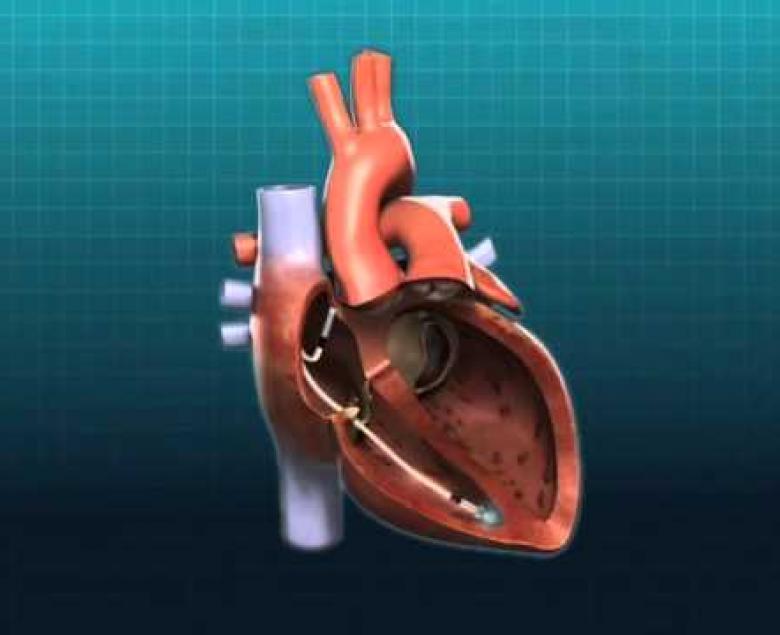Embedded thumbnail for Heart Pacemakers